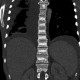 Unknown pathology of spine: CT - Computed tomography